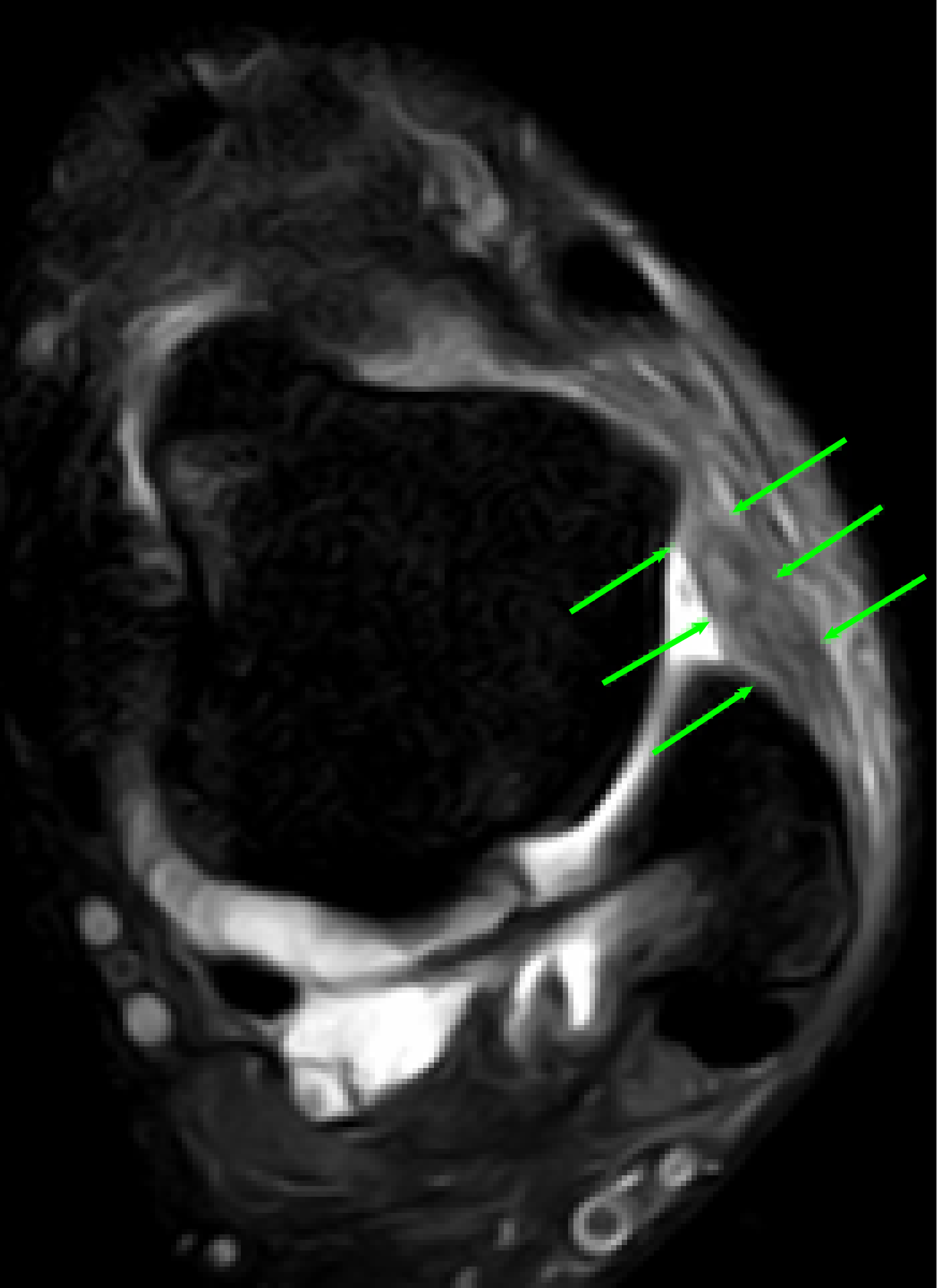 Chronic Ankle Instability FAQs | Foot and Ankle | Doctor Articles
